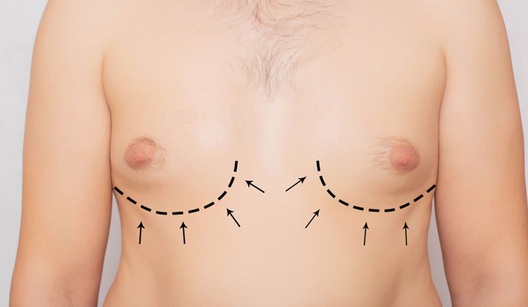 Gynecomastia Surgery: Understanding the Procedure, Benefits, and Recovery