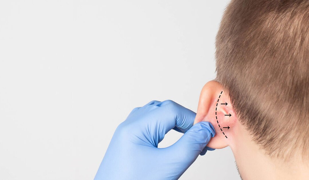 Otoplasty Surgery: Reshaping Your Ear Aesthetics for a Confident You