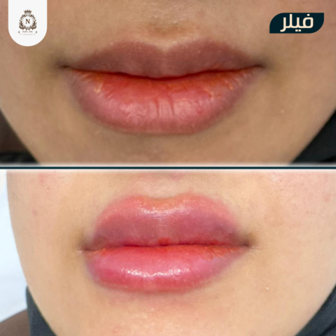Before and after case, Dr. Nesma Adel clinic 11