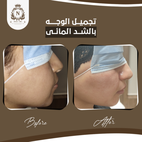 Before and after case, Dr. Nesma Adel clinic 8