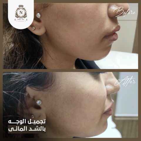 Before and after case, Dr. Nesma Adel clinic 7