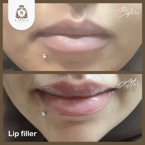 Before and after case, Dr. Nesma Adel clinic 10