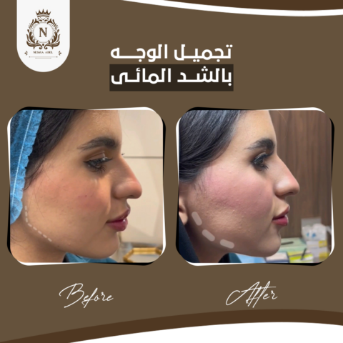 Before and after case, Dr. Nesma Adel clinic 6