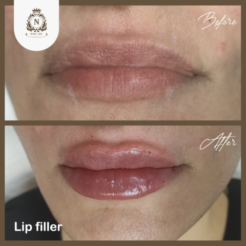 Before and after case, Dr. Nesma Adel clinic 9