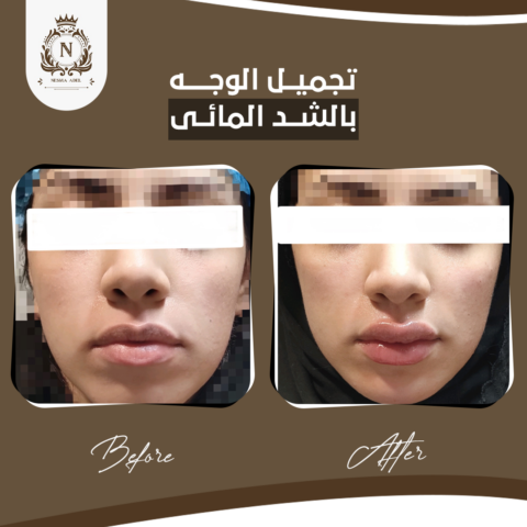 Before and after case, Dr. Nesma Adel clinic 5