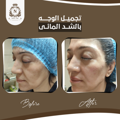 Before and after case, Dr. Nesma Adel clinic 4