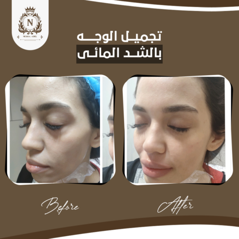 Before and after case, Dr. Nesma Adel clinic 3