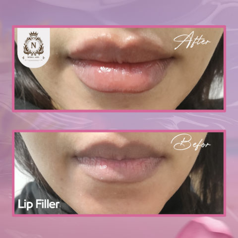 Before and after case, Dr. Nesma Adel clinic 1